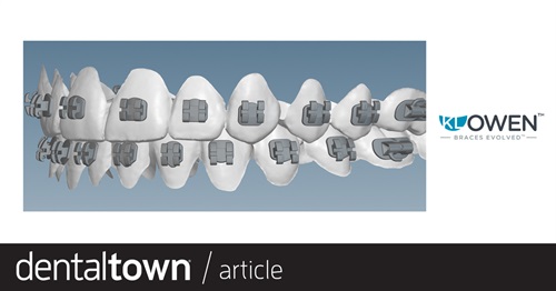 Product Profile: KLOwen Braces A 100% custom braces system